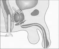 Применение в урологии и андрологии