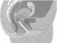 Применение в гинекологии и акушерстве