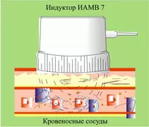 Повышение защитных свойств организма (иммунитета) - надвенное омагничивание крови